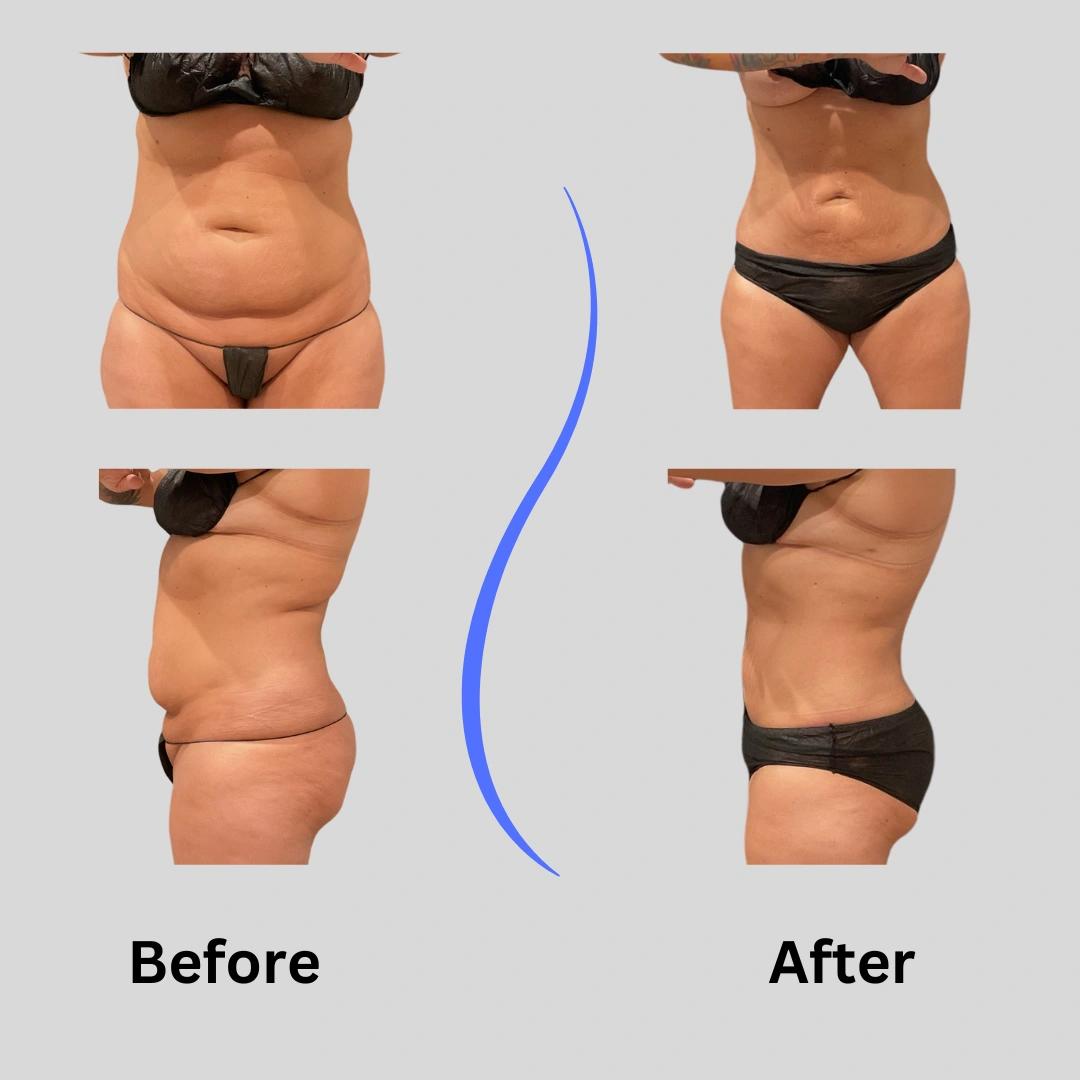 Real Patient Results preformed by Dr. Ryan Mcgovern in Brookfield and Appleton, WI.