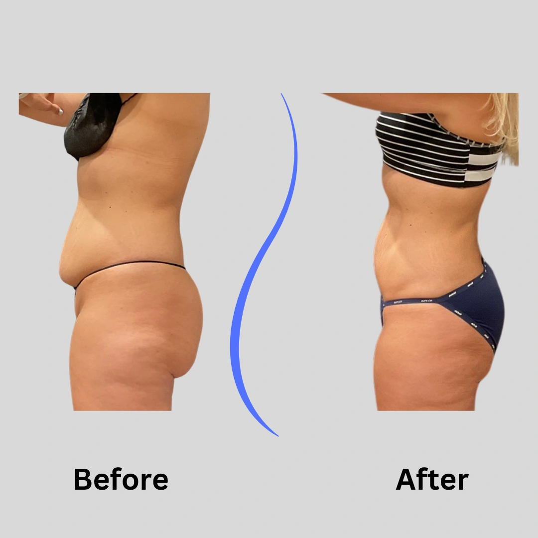 Real Patient Results preformed by Dr. Ryan Mcgovern in Brookfield and Appleton, WI.