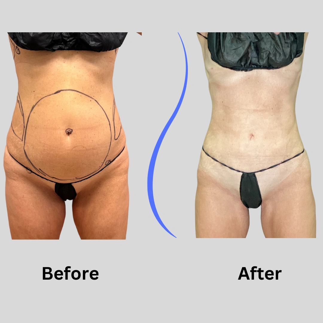Real Patient Results preformed by Dr. Ryan Mcgovern in Brookfield and Appleton, WI.