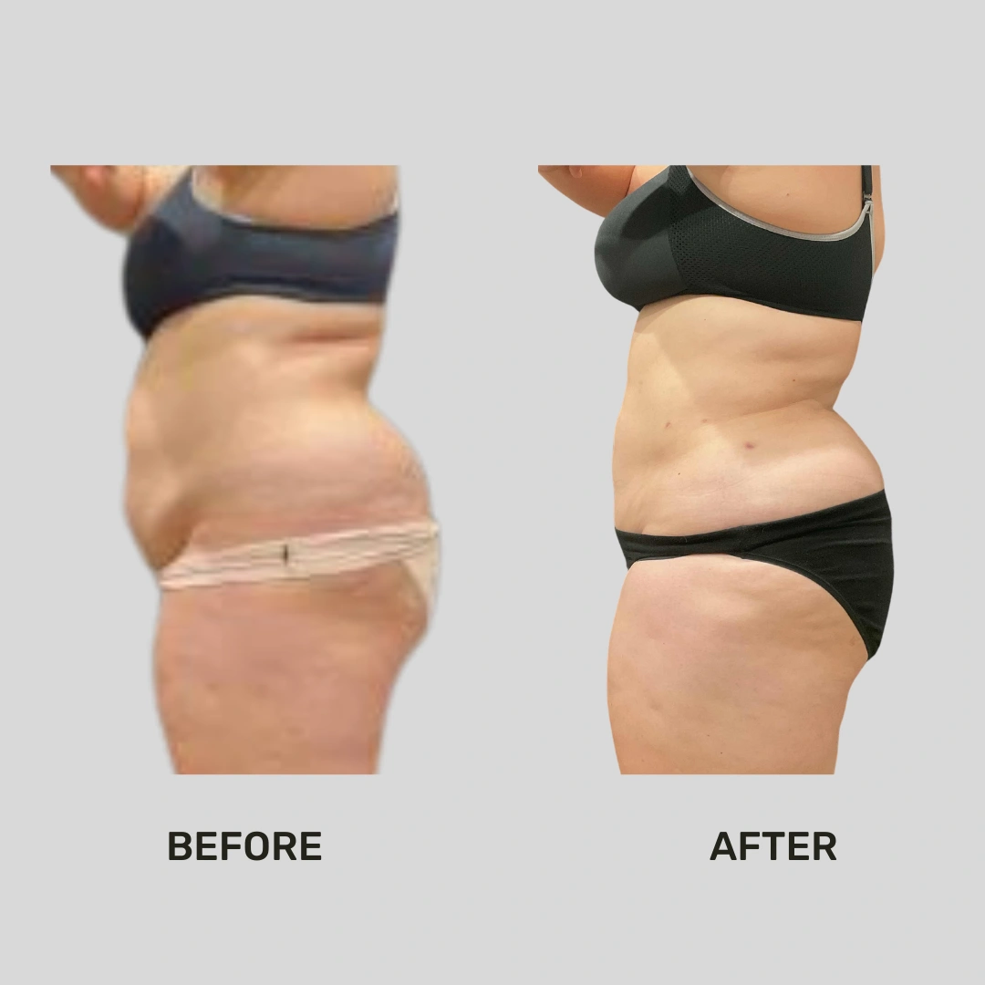 Real Patient Results preformed by Dr. Ryan Mcgovern in Brookfield and Appleton, WI.
