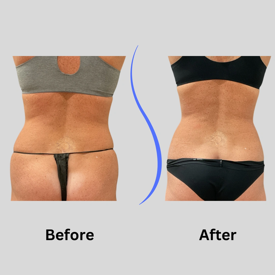Real Patient Results preformed by Dr. Ryan Mcgovern in Brookfield and Appleton, WI.