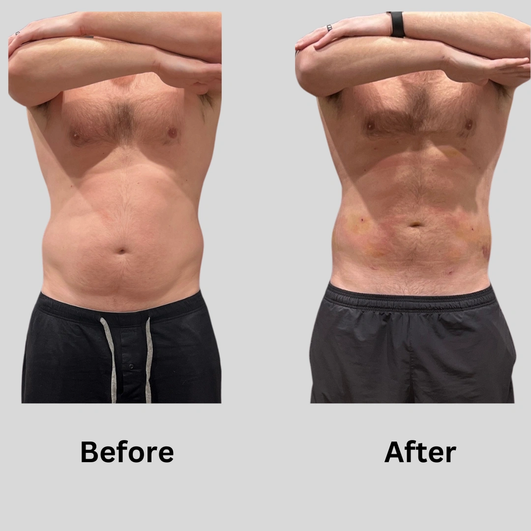 Real Patient Results preformed by Dr. Ryan Mcgovern in Brookfield and Appleton, WI.