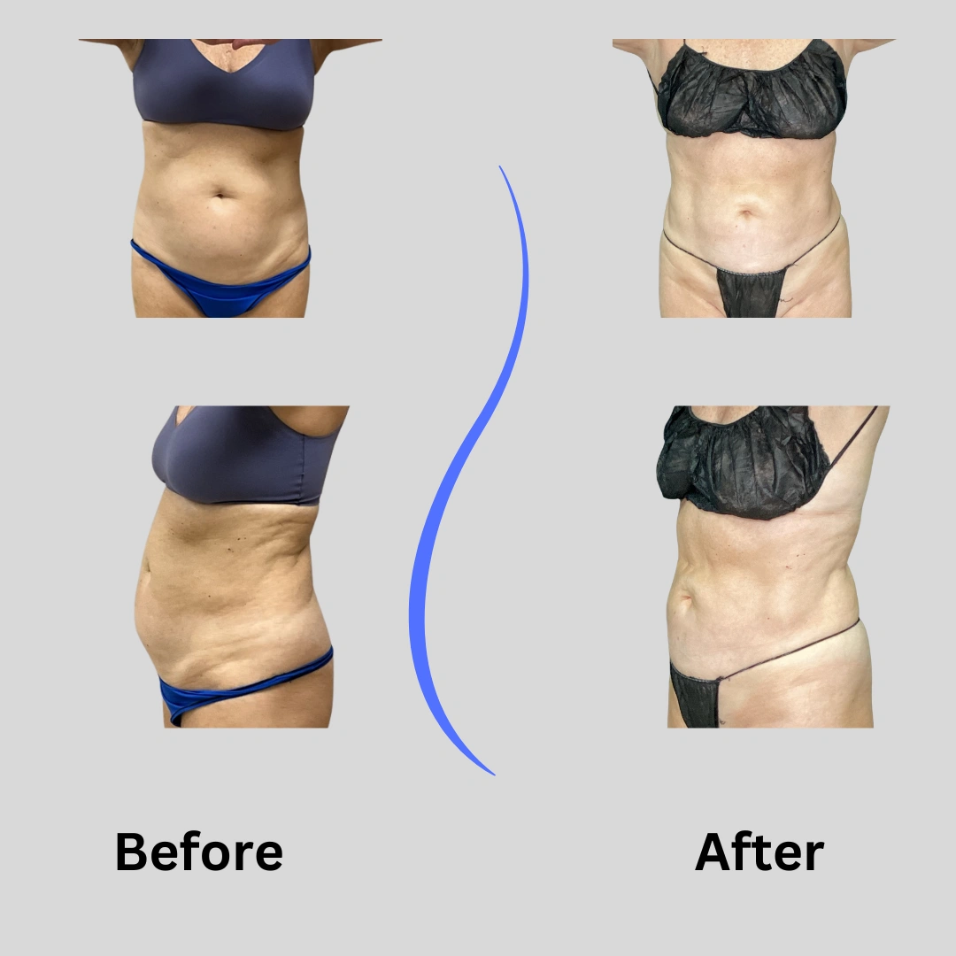 Real Patient Results preformed by Dr. Ryan Mcgovern in Brookfield and Appleton, WI.