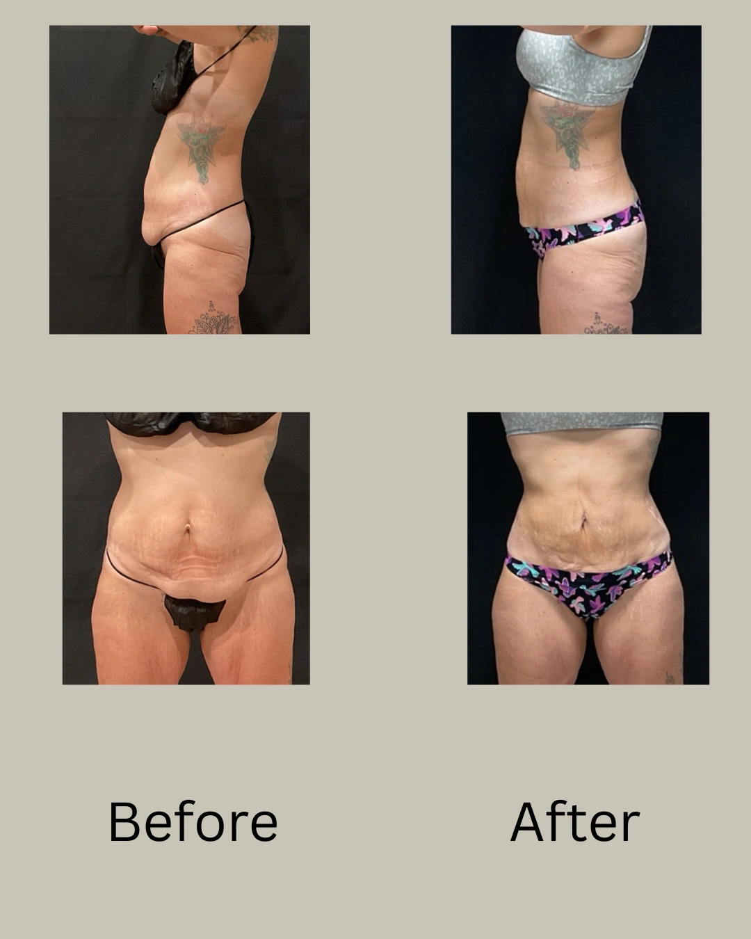 Real Patient Results preformed by Dr. Ryan Mcgovern in Brookfield and Appleton, WI.