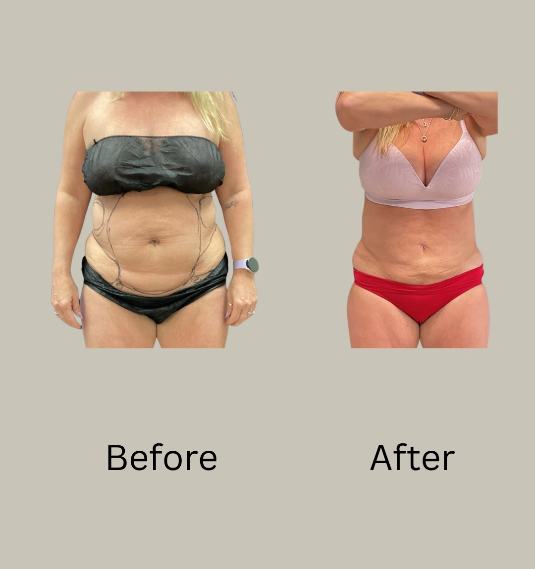 Real Patient Results preformed by Dr. Ryan Mcgovern in Brookfield and Appleton, WI.