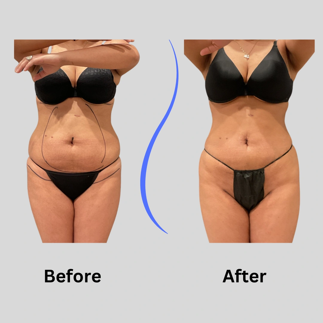 Real Patient Results preformed by Dr. Ryan Mcgovern in Brookfield and Appleton, WI.