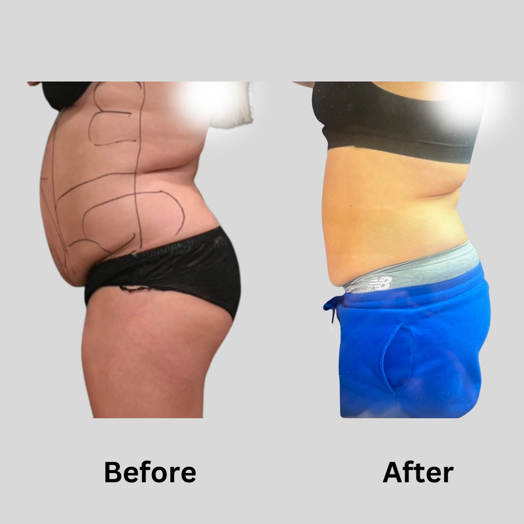 Real Patient Results preformed by Dr. Ryan Mcgovern in Brookfield and Appleton, WI.