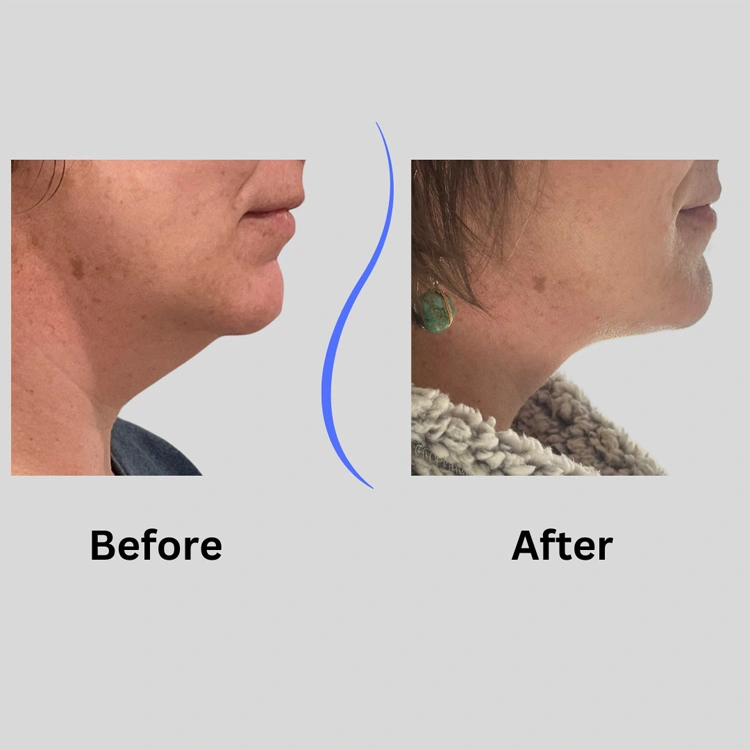 Before and after photos showing chin and neck profile improvement from cosmetic procedure