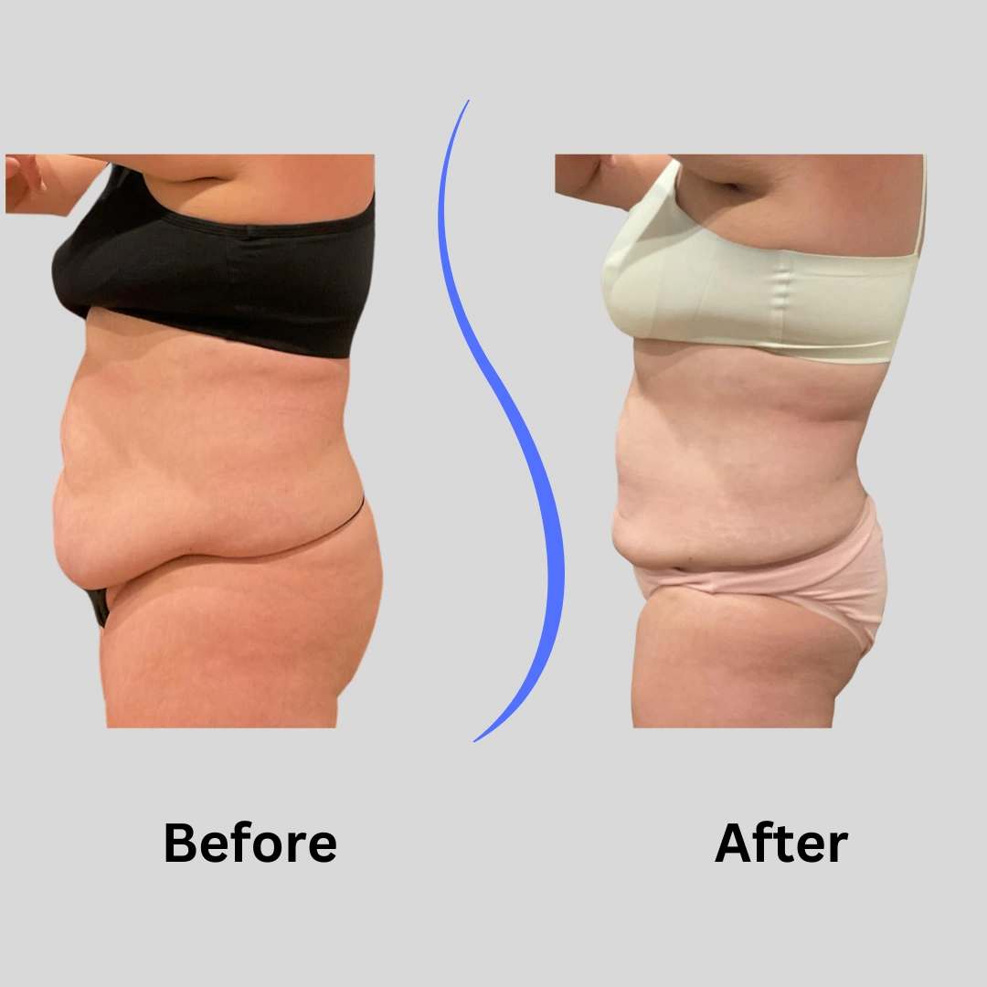 Real Patient Results preformed by Dr. Ryan Mcgovern in Brookfield and Appleton, WI.