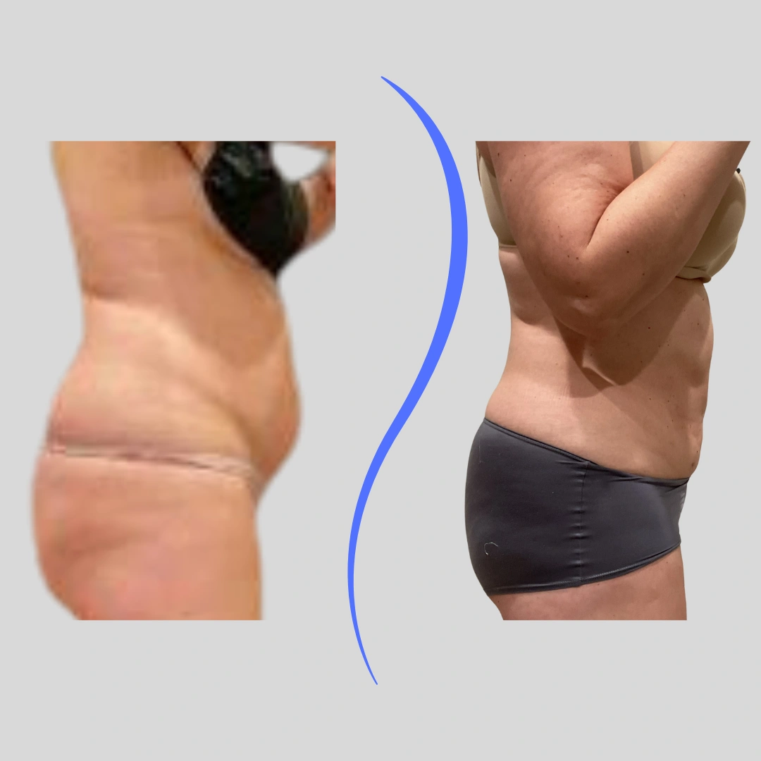 Real Patient Results preformed by Dr. Ryan Mcgovern in Brookfield and Appleton, WI.