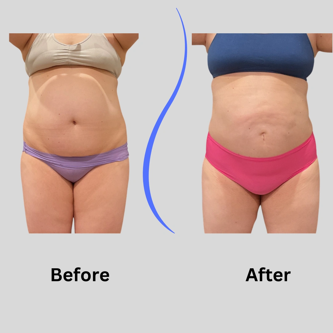 Real Patient Results preformed by Dr. Ryan Mcgovern in Brookfield and Appleton, WI.