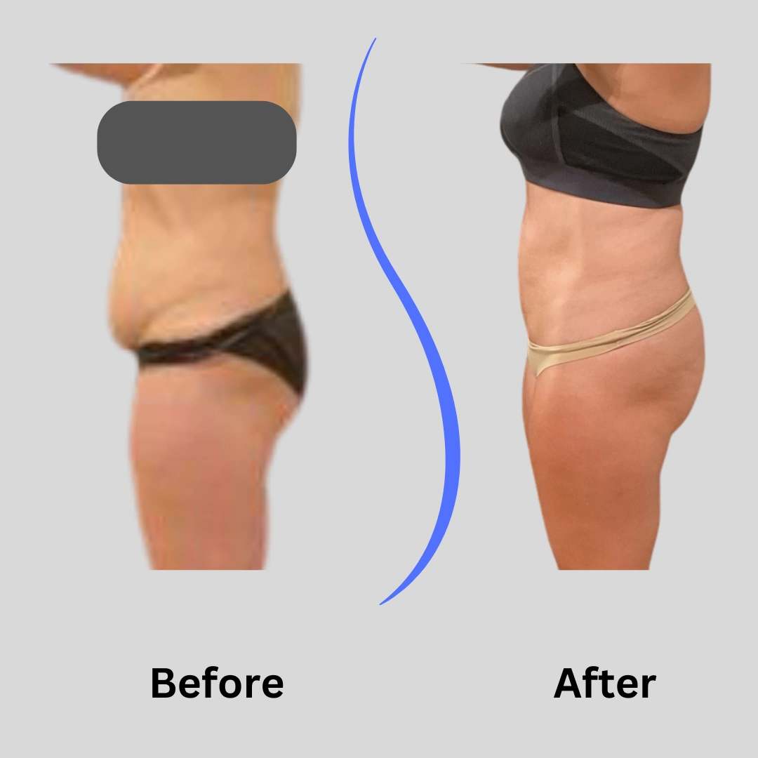 Real Patient Results preformed by Dr. Ryan Mcgovern in Brookfield and Appleton, WI.