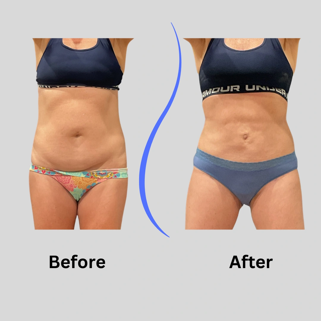 Real Patient Results preformed by Dr. Ryan Mcgovern in Brookfield and Appleton, WI.
