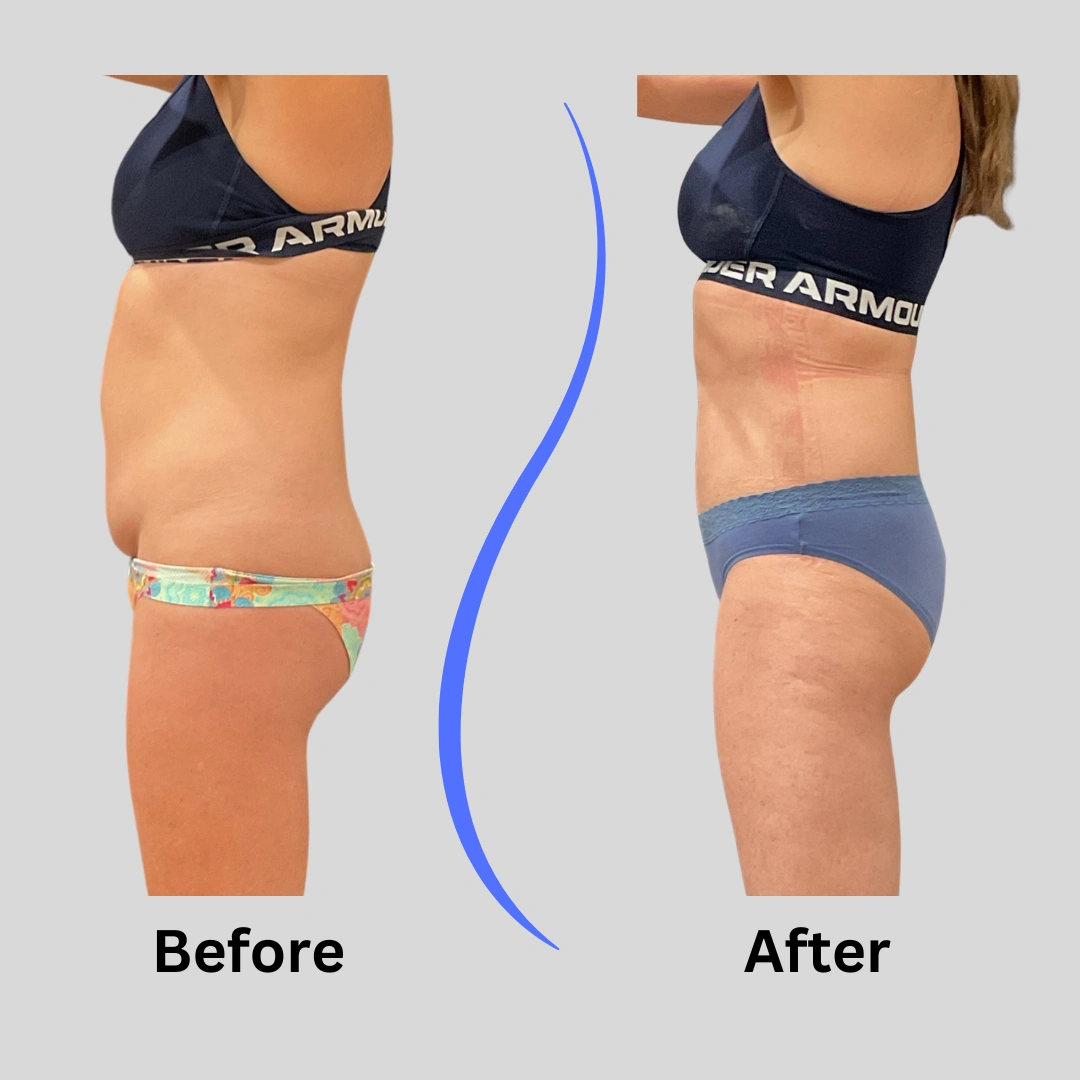 Real Patient Results preformed by Dr. Ryan Mcgovern in Brookfield and Appleton, WI.