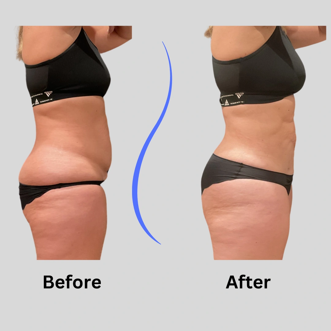 Real Patient Results preformed by Dr. Ryan Mcgovern in Brookfield and Appleton, WI.