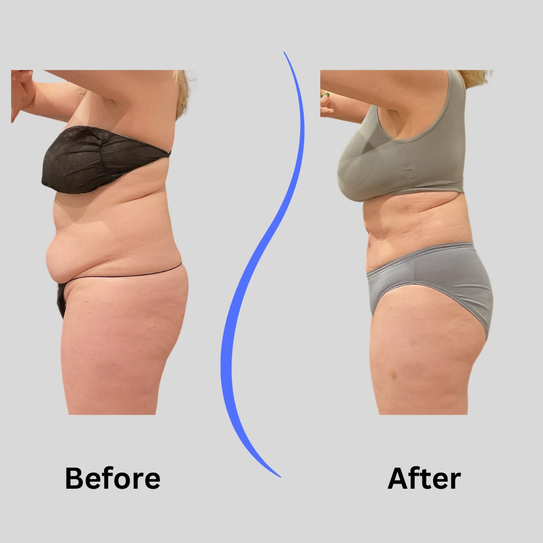 Real Patient Results preformed by Dr. Ryan Mcgovern in Brookfield and Appleton, WI.