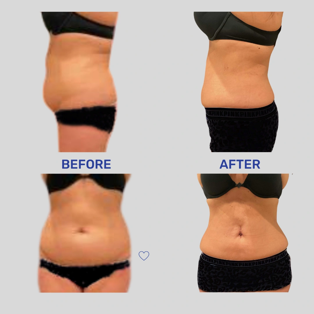 Real Patient Results preformed by Dr. Ryan Mcgovern in Brookfield and Appleton, WI.