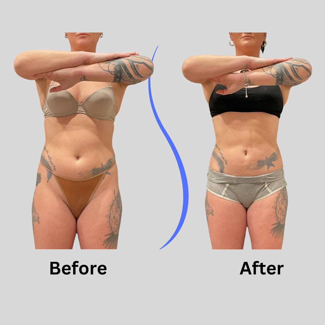 Real Patient Results preformed by Dr. Ryan Mcgovern in Brookfield and Appleton, WI.