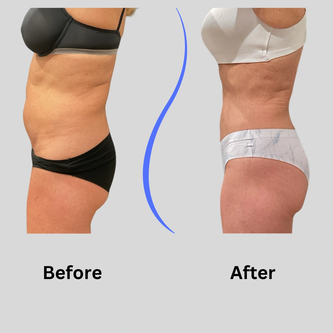 Real Patient Results preformed by Dr. Ryan Mcgovern in Brookfield and Appleton, WI.