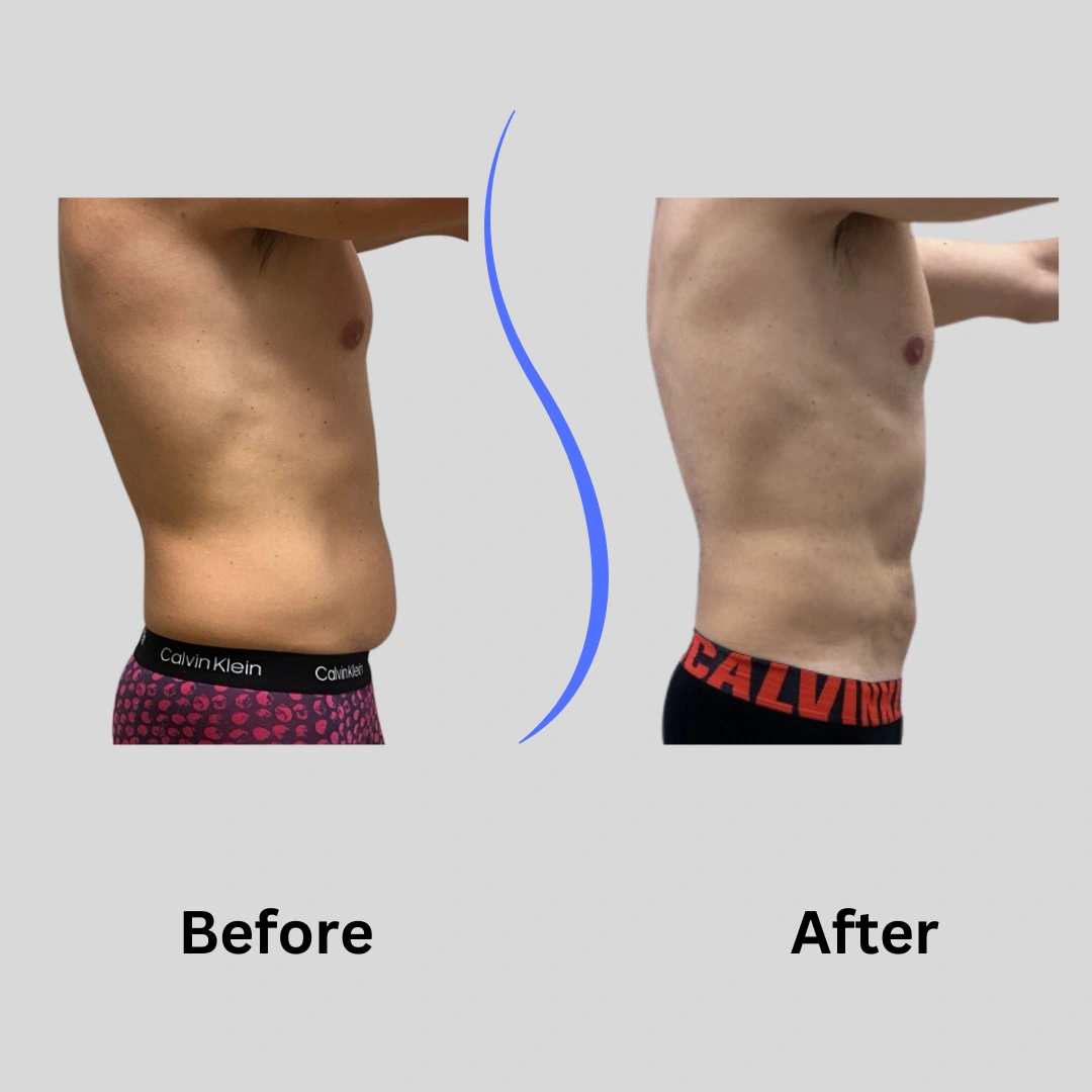 Real Patient Results preformed by Dr. Ryan Mcgovern in Brookfield and Appleton, WI.