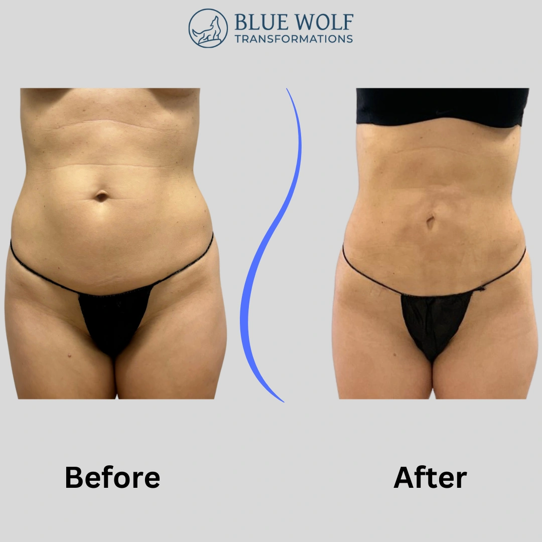 Real Patient Results preformed by Dr. Ryan Mcgovern in Brookfield and Appleton, WI.