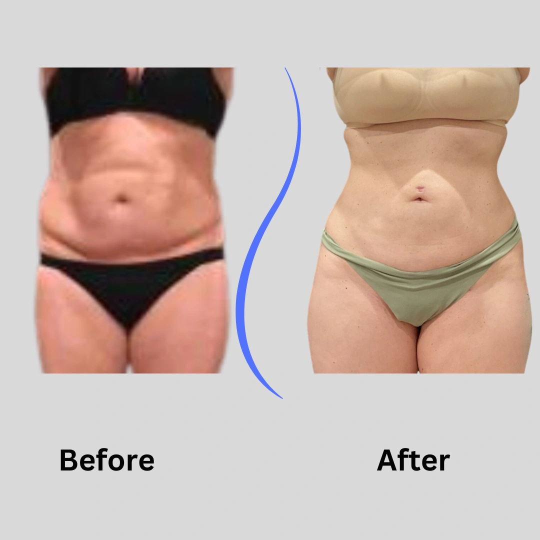 Real Patient Results preformed by Dr. Ryan Mcgovern in Brookfield and Appleton, WI.