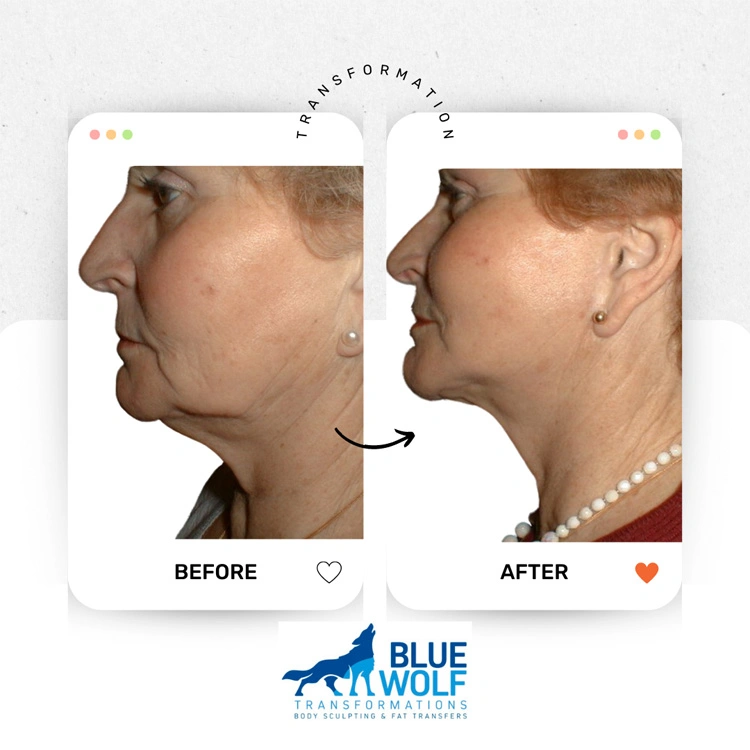 Real patient results In Appleton, Brookfield, Milwaukee, WI & Gurnee, IL