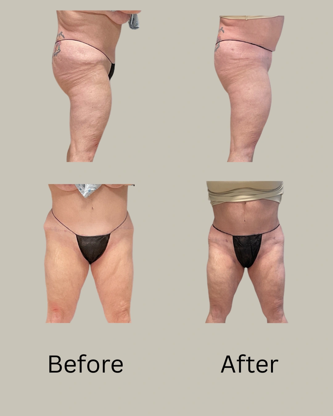 Before and after body contouring results showing thigh and hip reduction from multiple angles