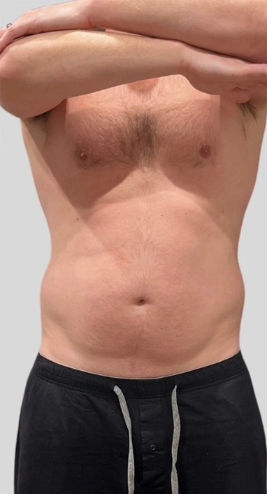 before-abs_flanks