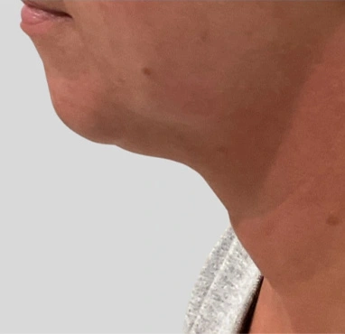 Real patient results In Appleton, Brookfield, Milwaukee, WI & Gurnee, IL