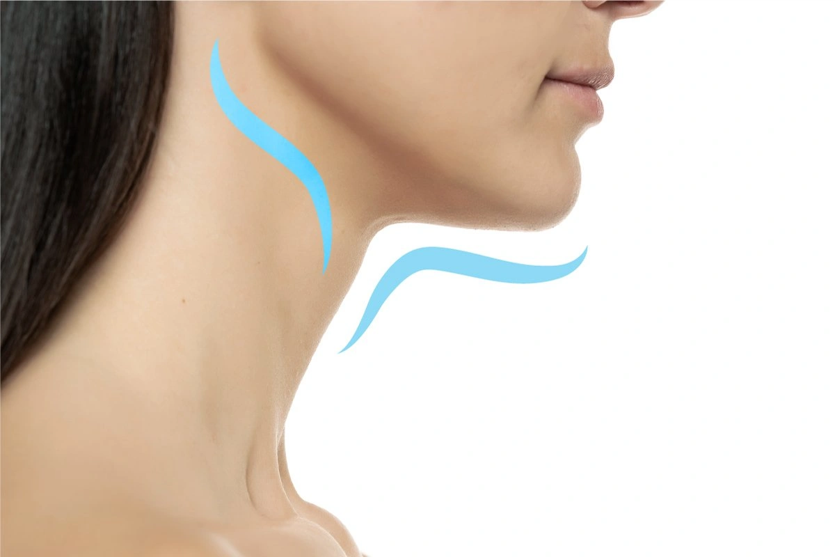 Woman's neck and jawline with blue outline showing facial contour for cosmetic surgery consultation - Chin and neck In Appleton, Brookfield, Milwaukee, WI & Gurnee, IL