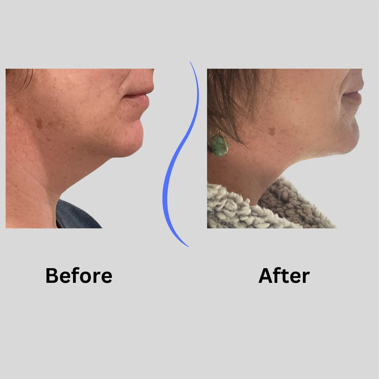 Real patient results In Appleton, Brookfield, Milwaukee, WI & Gurnee, IL