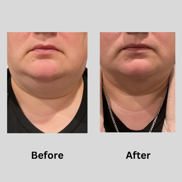 Real patient results In Appleton, Brookfield, Milwaukee, WI & Gurnee, IL