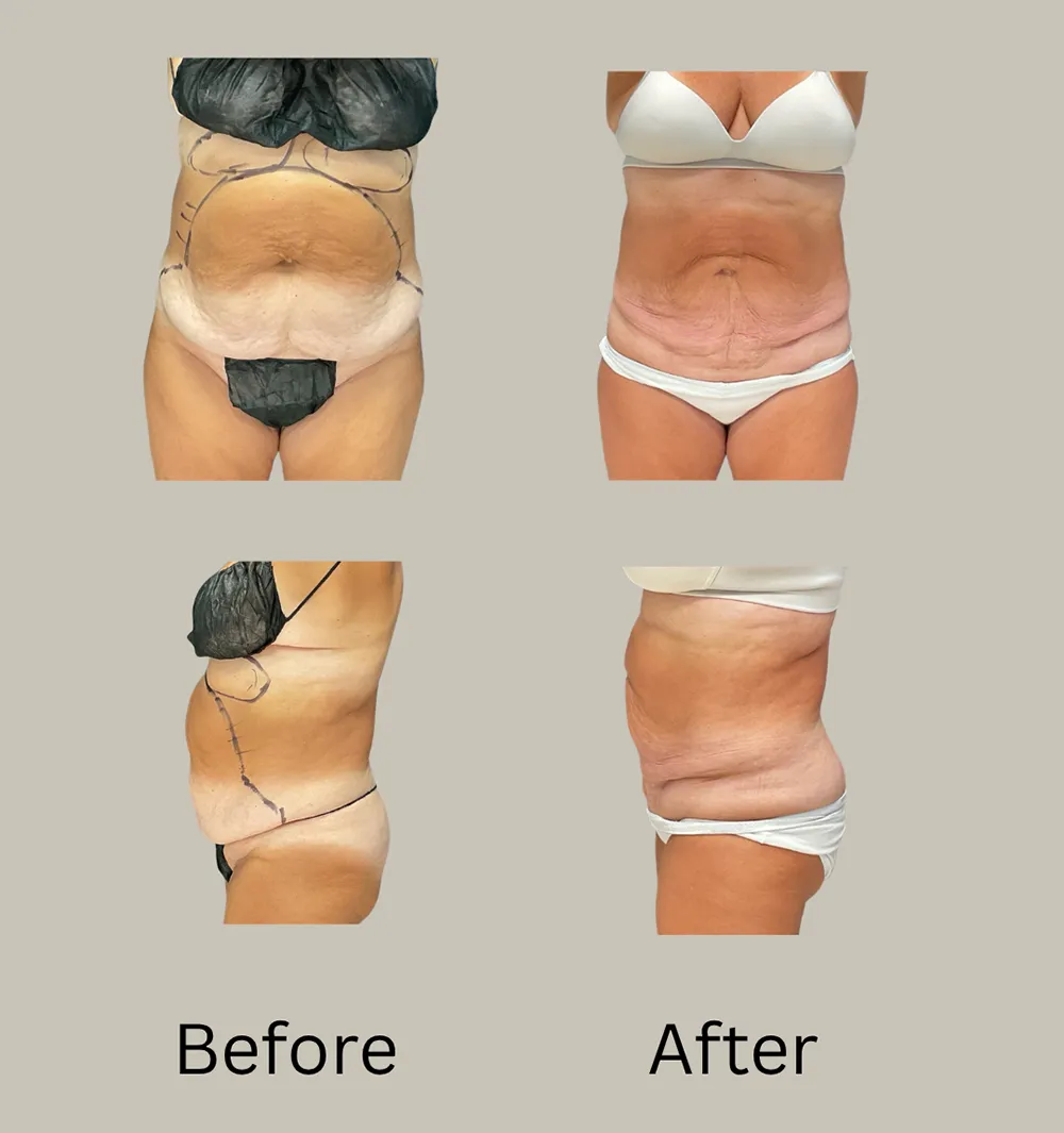 LE before after