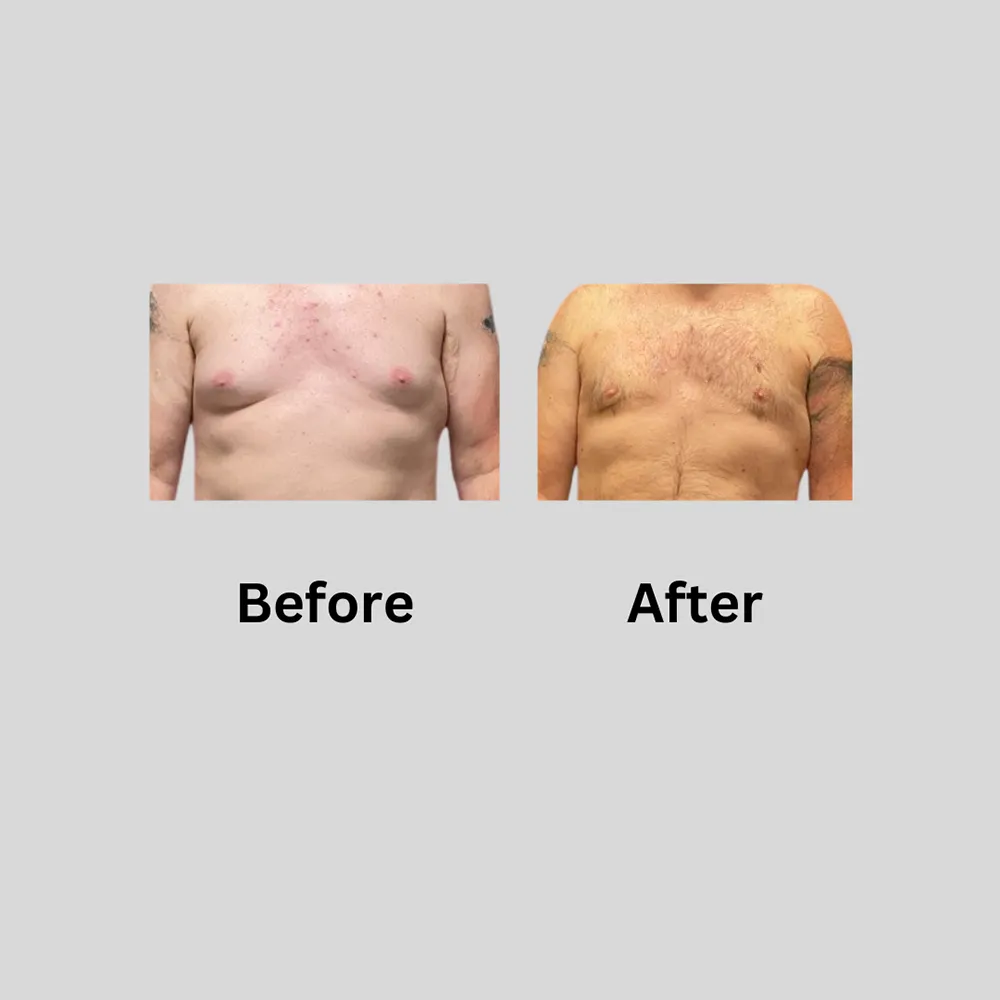 Male Chest b4 after