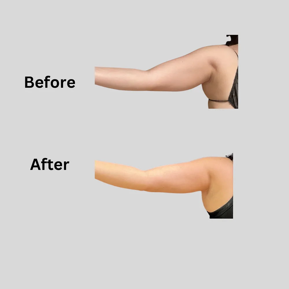 Arms VB b4 aftr